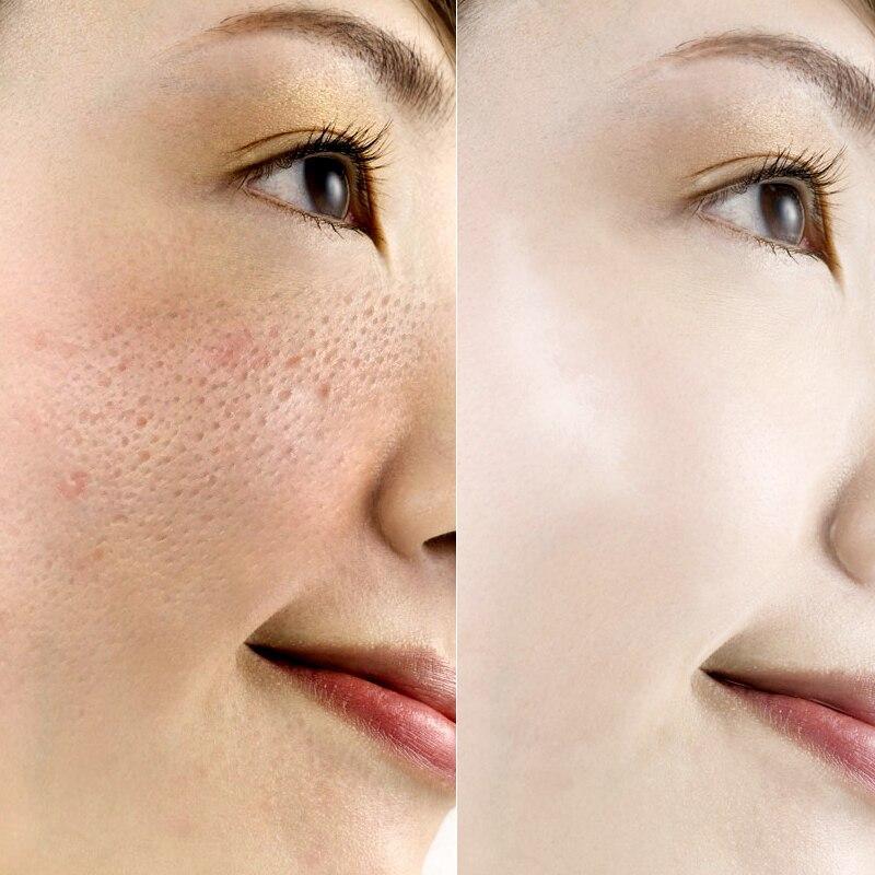 Soro de Arroz Branco para Limpeza Facial - Rorec